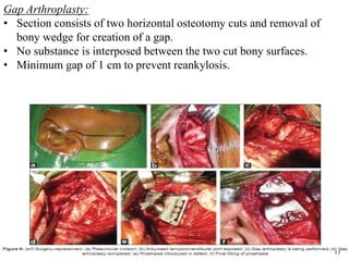 Gap Arthroplasty:
• Section consists of two horizontal osteotomy cuts and removal of
bony wedge for creation of a gap.
• No substance is interposed between the two cut bony surfaces.
• Minimum gap of 1 cm to prevent reankylosis.
17
 