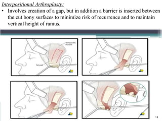 Interpositional Arthroplasty:
• Involves creation of a gap, but in addition a barrier is inserted between
the cut bony surfaces to minimize risk of recurrence and to maintain
vertical height of ramus.
18
 