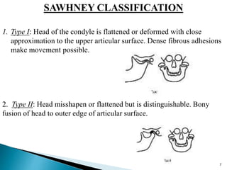SAWHNEY CLASSIFICATION
1. Type I: Head of the condyle is flattened or deformed with close
approximation to the upper articular surface. Dense fibrous adhesions
make movement possible.
2. Type II: Head misshapen or flattened but is distinguishable. Bony
fusion of head to outer edge of articular surface.
7
 