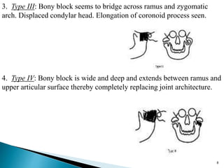 8
3. Type III: Bony block seems to bridge across ramus and zygomatic
arch. Displaced condylar head. Elongation of coronoid process seen.
4. Type IV: Bony block is wide and deep and extends between ramus and
upper articular surface thereby completely replacing joint architecture.
 