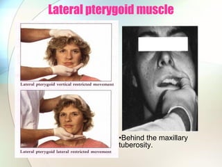 Lateral pterygoid muscle
•Behind the maxillary
tuberosity.
 