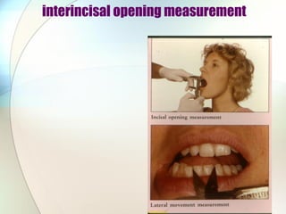 interincisal opening measurement
 