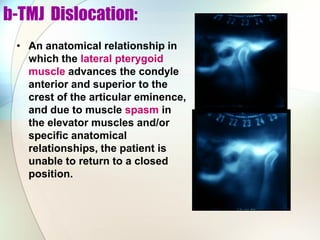 b-TMJ Dislocation:
• An anatomical relationship in
which the lateral pterygoid
muscle advances the condyle
anterior and superior to the
crest of the articular eminence,
and due to muscle spasm in
the elevator muscles and/or
specific anatomical
relationships, the patient is
unable to return to a closed
position.
 