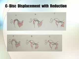 C- Disc Displacement with Reduction
 