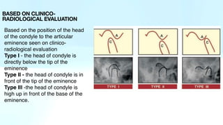 Based on the position of the head
of the condyle to the articular
eminence seen on clinico-
radiological evaluation
Type I - the head of condyle is
directly below the tip of the
eminence
Type II - the head of condyle is in
front of the tip of the eminence
Type Ill -the head of condyle is
high up in front of the base of the
eminence.
BASED ON CLINICO-
RADIOLOGICAL EVALUATION
 