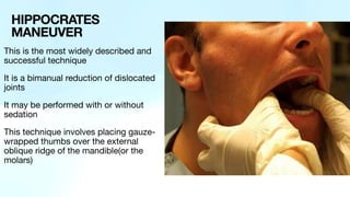 This is the most widely described and
successful technique
It is a bimanual reduction of dislocated
joints
It may be performed with or without
sedation
This technique involves placing gauze-
wrapped thumbs over the external
oblique ridge of the mandible(or the
molars)
HIPPOCRATES
MANEUVER
 