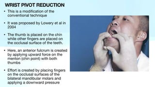 • This is a modification of the
conventional technique
• It was proposed by Lowery et al in
2004
• The thumb is placed on the chin
while other fingers are placed on
the occlusal surface of the teeth.
• Here, an anterior fulcrum is created
by applying upward force on the
menton (chin point) with both
thumbs
• Effort is created by placing fingers
on the occlusal surfaces of the
bilateral mandibular molars and
applying a downward pressure
WRIST PIVOT REDUCTION
 