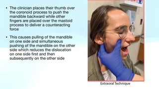 • The clinician places their thumb over
the coronoid process to push the
mandible backward while other
fingers are placed over the mastoid
process to deliver a counteracting
force
• This causes pulling of the mandible
on one side and simultaneous
pushing of the mandible on the other
side which reduces the dislocation
on one side first and then
subsequently on the other side
 