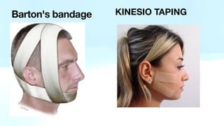 KINESIO TAPING
Barton's bandage
 