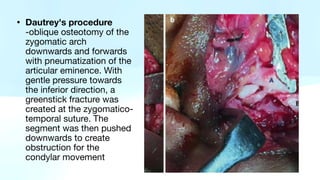 • Dautrey's procedure
-oblique osteotomy of the
zygomatic arch
downwards and forwards
with pneumatization of the
articular eminence. With
gentle pressure towards
the inferior direction, a
greenstick fracture was
created at the zygomatico-
temporal suture. The
segment was then pushed
downwards to create
obstruction for the
condylar movement
 