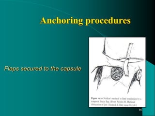 Flaps secured to the capsule
46
 