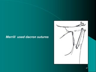 Merrill used dacron sutures
47
 