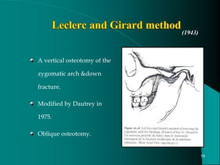 A vertical osteotomy of the
zygomatic arch &down
fracture.
Modified by Dautrey in
1975.
Oblique osteotomy.
(1943)
50
 