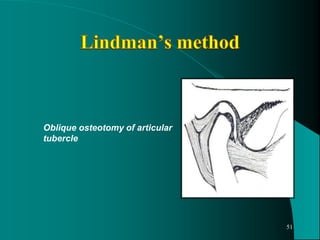 Oblique osteotomy of articular
tubercle
51
 