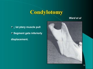 ↓ lat ptery muscle pull
Segment gets inferiorly
displacement.
Ward et al
58
 