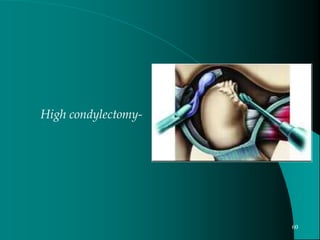 High condylectomy-
60
 