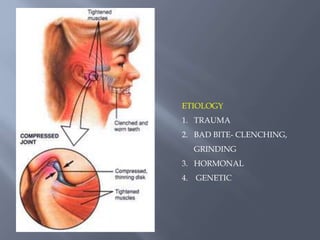 ETIOLOGY
1. TRAUMA
2. BAD BITE- CLENCHING,
GRINDING
3. HORMONAL
4. GENETIC
 