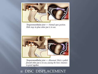  DISC DISPLACEMENT
 