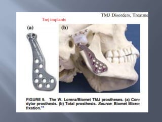 Tmj implants
 