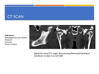 Comprehensive Overview of Temporomandibular Joint Disorders: Anatomy ...