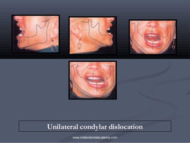 tmj dislocation unilateral disorders condylar fellowships orthodontics bilateral indiandentalacademy sanjay