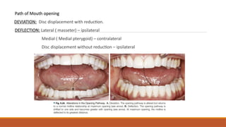 Tmj Deviation Deflection TMJ DISORDERS IN ORTHODONTICS as require | PPTX