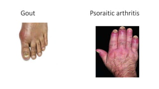 Gout Psoraitic arthritis
 