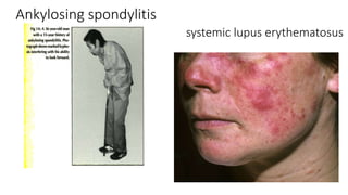 Ankylosing spondylitis
systemic lupus erythematosus
 