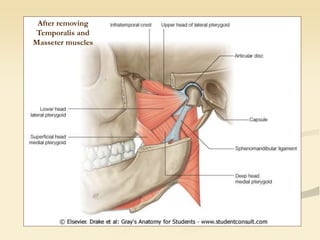 After removing
Temporalis and
Masseter muscles
 