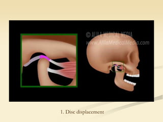 1. Disc displacement
 
