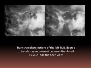 Transcranial projections of the left TMJ. degree
 of translatory movement between the closed
           view (A) and the open view
 