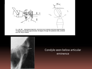 Condyle seen below articular
         eminence
 