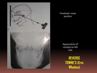 Forehead –nose
   position




  Appreciation of
  condyle on left
       side


      REVERSE
    TOWNE’S (Eric
      Whaites)
 