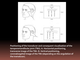 Positioning of the transducer and consequent visualization of the
temporomandibular joint (TMJ). A. Horizontal positioning,
transverse image of the TMJ. B. Vertical positioning,
coronal/sagittal image of the TMJ (depending on the angulation of
the transducer).
 