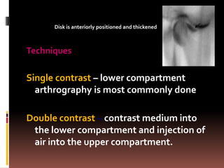 Disk is anteriorly positioned and thickened



Techniques

Single contrast – lower compartment
  arthrography is most commonly done

Double contrast – contrast medium into
 the lower compartment and injection of
 air into the upper compartment.
 