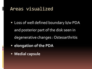 Areas visualized

 Loss of well defined boundary b/w PDA
 and posterior part of the disk seen in
 degenerative changes : Osteoarthritis

 elongation of the PDA

 Medial capsule
 