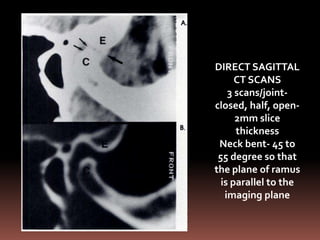 DIRECT SAGITTAL
      CT SCANS
    3 scans/joint-
closed, half, open-
      2mm slice
      thickness
 Neck bent- 45 to
 55 degree so that
the plane of ramus
  is parallel to the
   imaging plane
 