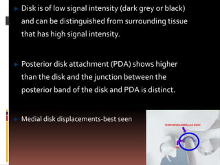 Disk is of low signal intensity (dark grey or black)
and can be distinguished from surrounding tissue
that has high signal intensity.


Posterior disk attachment (PDA) shows higher
than the disk and the junction between the
posterior band of the disk and PDA is distinct.


Medial disk displacements-best seen
 