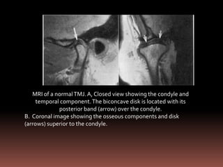 MRI of a normal TMJ. A, Closed view showing the condyle and
     temporal component. The biconcave disk is located with its
             posterior band (arrow) over the condyle.
B. Coronal image showing the osseous components and disk
(arrows) superior to the condyle.
 
