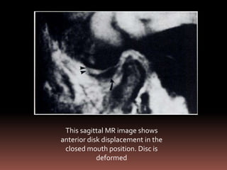This sagittal MR image shows
anterior disk displacement in the
 closed mouth position. Disc is
            deformed
 