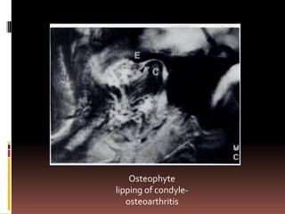 Osteophyte
lipping of condyle-
   osteoarthritis
 
