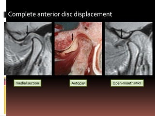 Complete anterior disc displacement




  medial section     Autopsy          Open-mouth MRI
 