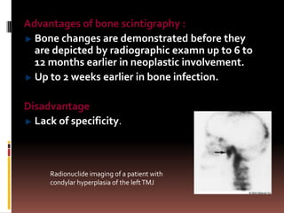 Advantages of bone scintigraphy :
  Bone changes are demonstrated before they
  are depicted by radiographic examn up to 6 to
  12 months earlier in neoplastic involvement.
  Up to 2 weeks earlier in bone infection.

Disadvantage
  Lack of specificity.



     Radionuclide imaging of a patient with
     condylar hyperplasia of the left TMJ
 
