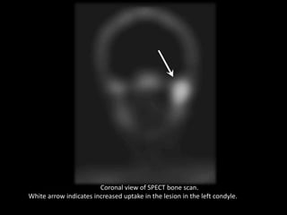 Coronal view of SPECT bone scan.
White arrow indicates increased uptake in the lesion in the left condyle.
 