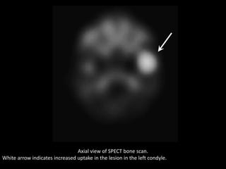Axial view of SPECT bone scan.
White arrow indicates increased uptake in the lesion in the left condyle.
 