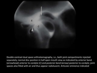 Double-contrast dual space arthrotomography, i.e., both joint compartments injected
separately; normal disc position in half open mouth view as indicated by anterior band
(arrowhead) anterior to condyle (C) and posterior band (arrow) posterior to condyle; joint
spaces also filled with air and thus appear radiolucent. Articular eminence indicated
 