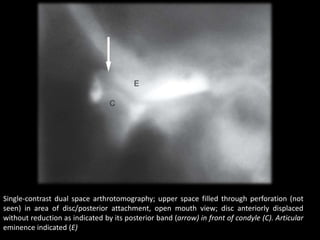 Single-contrast dual space arthrotomography; upper space filled through perforation (not
seen) in area of disc/posterior attachment, open mouth view; disc anteriorly displaced
without reduction as indicated by its posterior band (arrow) in front of condyle (C). Articular
eminence indicated (E)
 
