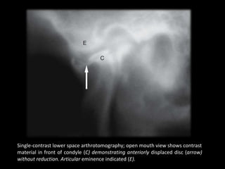 Single-contrast lower space arthrotomography; open mouth view shows contrast
material in front of condyle (C) demonstrating anteriorly displaced disc (arrow)
without reduction. Articular eminence indicated (E).
 