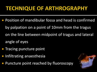  Position of mandibular fossa and head is confirmed
by palpation on a point of 10mm from the tragus
on the line between midpoint of tragus and lateral
angle of eyes
 Tracing puncture point
 Infiltrating anaesthesia
 Puncture point reached by fluoroscopy
 