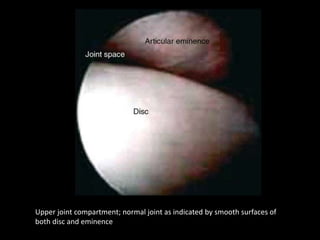 Upper joint compartment; normal joint as indicated by smooth surfaces of
both disc and eminence
 